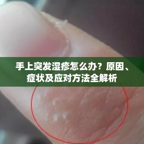 手上突發(fā)濕疹怎么辦？原因、癥狀及應(yīng)對方法全解析